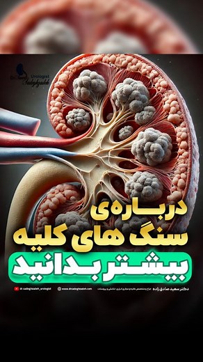 ‎اورولوژیست|متخصص اورولوژی|پروتز آلت تناسلی|دکتر سعید صادق زاده‎ on Instagram‎: "🔎 همه چیز درباره سنگ کلیه! 🩺💎 سنگ کلیه یکی از مشکلات رایج کلیویه که می‌تونه درد شدیدی ایجاد کنه! 🤕 اما چطور تشکیل می‌شه 🤔💧 ✨ پست امشب رو از دست ندید! ✨ 👨🏻‍⚕️دکتر سعید صادق زاده جراح و‌ متخصص کلیه و مجاری ادراری-تناسلی و پروستات دوره تکمیلی PCNL و لاپاراسکوپی @dr.sadeghzadeh_urologist @dr.sadeghzadeh_urologist . 🩺خدمات: 🔹درمانهای اندوسکوپیک سنگ کلیه (TUL,PCNL,RIRS ) 🔸درمان پیشرفته ی اختلال نعوظ(SHOCKWAVE,پ