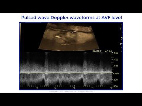 Iatrogenic arterio venous fistula between the superficial femoral artery and the common femoral vein