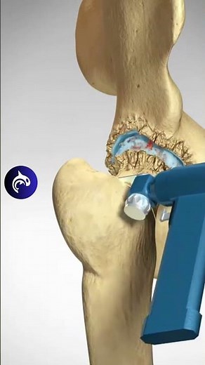 Total Hip Replacement (Arthroplasty) - 3D Animation