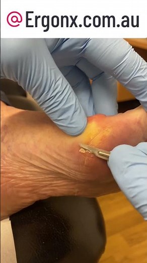 Aussie Podiatrist's Secret to Effortless Callus Removal #FootCare #Podiatry