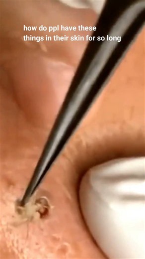 how do people have these things in their skin for so long