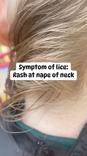 35K views · 66 reactions | Rash at the nape of the neck can sometimes be an indication of head lice.. the nape of the neck is a hot spot for head lice and many of my client experience rashes there, but as soon as they treated for lice the rash is gone #lice #momlife #hair #piojos #explore #school | Stacey The Louse Lady | Facebook
