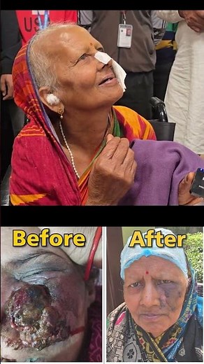 ANGIOSARCOMA Treatment | Side Effects Of Biopsy | Last Stage Cancer | Hiims Hospital