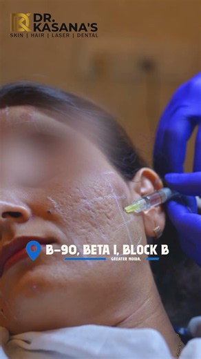 PDRN + BOTOX GLOW TREATMENT | Wrinkle Removal and Brightening #glowingskin #shorts