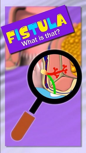 Fistula- When your body builds wrong tunnels. Piles/ Fissure/ Abscess