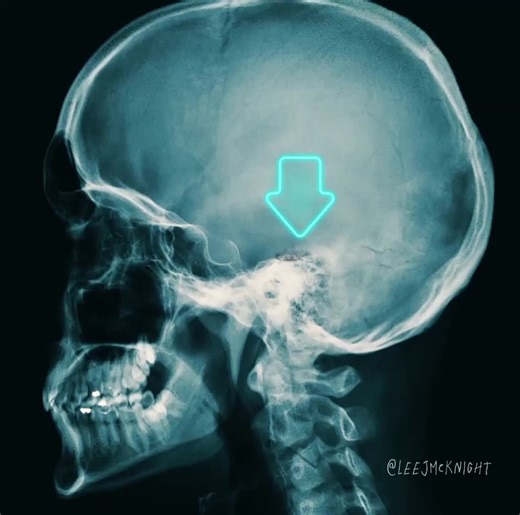 Terrifying Encounter: Cockroach Nesting In Ear Canal