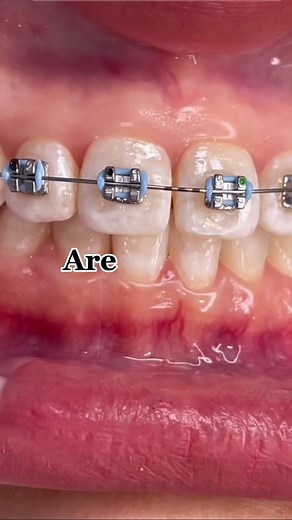 Don't Be Scared to Get Braces: The Complete Process Explained
