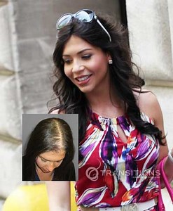 Reallusions Non-Surgical Hair Replacement for Women