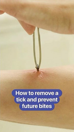How to remove a tick and prevent future bites #tickseason #tickremoval