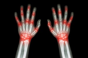 Arthritis in the Elderly