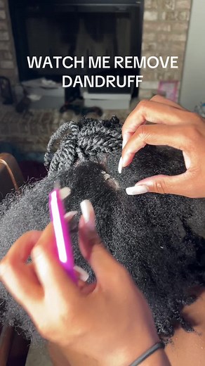 Dandruff Removal Techniques for Scalp Care