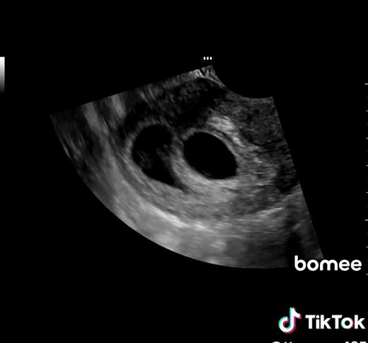 Understanding the 7-Week Ultrasound for Twins