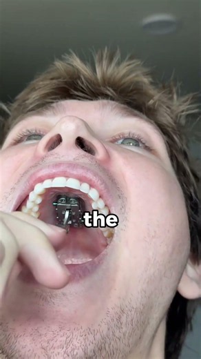 How palatal expanders widen your mouth (it's wild) #braces #teeth #orthodontist #shorts