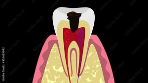 Tooth decay, dental caries and inflammation of the nerve of the tooth, pulpitis, HD alpha channel