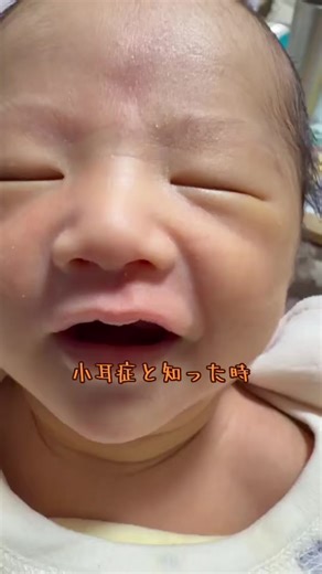 小耳症と向き合う母の葛藤