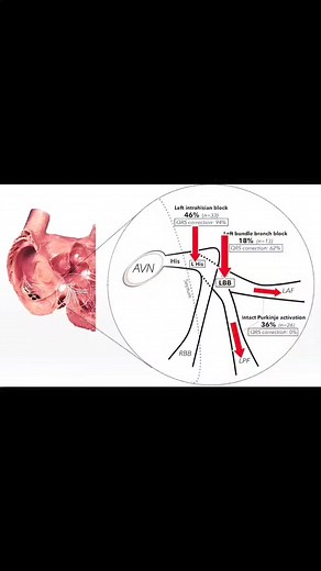 Sites of Conduction Block in Patients with Left Bundle Branch Block Pattern with Rate of Response to Corrective His Bundle Pacing , Comparing Theory of Longitudinal Dissociation with Finding of Conduction Block @WoltersKluwerHealth Arrhythmia & Electrophysiology Review 2020;9(1):28–33. #Cardiacresynchronisationtherapy #leftbundlebranchblock #lbbb #HeartConductivity #biventricularpacing #cardiology #electrophysiology | Abdallah Othman