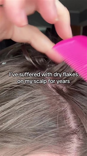 Effective Solutions for Flaky Scalp Treatment