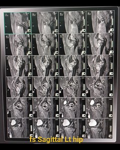 MRI of hip joints | CT Scan and MRI study