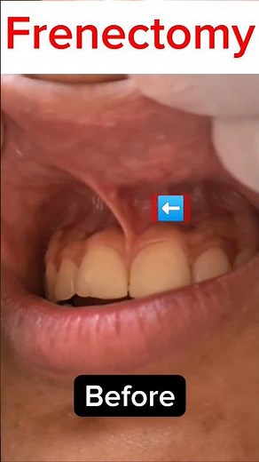 🇳🇵Frenectomy- Removal of High Labial Frenum| #youtubeshorts #trending #dentist