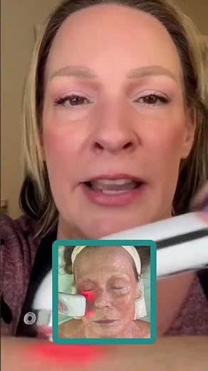 RF or Microcurrent? Here’s What Actually Lifts Your Skin