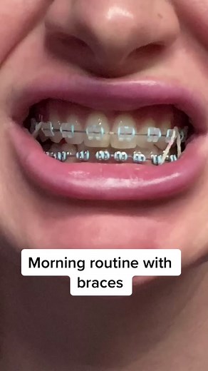 Braces Morning Routine Tips: How to Take Care of Your Braces