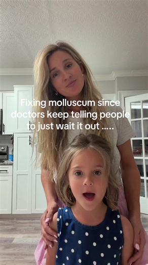 Asking young kids to wait six months to a year, which rarely is the case for it to go away on its own it’s not real realistic!!! these kids are losing their confidence and they’re spreading it to others while you tell us to wait!! go check out my other videos to see how we cured it on our own. Make sure to follow.!! #molluscumcontagiosum