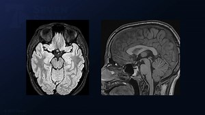#444: Pterional Transsylvian Approach for Resection of an Optic Chiasm Cavernous Malformation - All Videos - Seven Series Collection