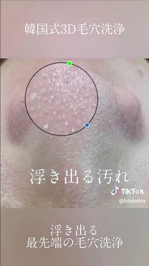 🐻熊本🐻 韓国式🇰🇷3D毛穴洗浄✨ 【浮き出る毛穴洗浄】 認定講師👩‍🏫 大阪、熊本で導入講習できます。 ※場合によっては出張講習可能🉑 毛穴のタイプはいろいろ。 ・黒ずみ毛穴 ・色素沈着毛穴 ・開き毛穴 ・たるみ毛穴 普通の黒ずみ毛穴は1度でも綺麗になります☆ クレンジング ↓ クレンジングスチーム ↓ 浮き出る毛穴汚れ吸引 ↓ 毛穴引き締め美容液 クレンジングスチームで驚くほど浮き出る毛穴汚れ♪ 根こそぎ吸引し、肌代謝UPで毛穴レス肌に☆ ◎韓国式🇰🇷3D毛穴洗浄(約90分) 14,000円 ↓ 初回 7,000円 全顔の毛穴を一度で綺麗にします✨ 安心してお任せください😊 #毛穴 #毛穴の黒ずみ #ブラックヘッド #毛穴洗浄 #韓国式3D毛穴洗浄 #韓国式3D毛穴洗浄認定講師 #韓国式3D毛穴洗浄熊本 #熊本エステ #熊本毛穴 #熊本美容 #熊本県 #熊本 #毛穴エクストラクション #ハイドラフェイシャル #ハイドロスプラッシュ #vosサロンケア #vosサロンケア熊本 #v3ファンデーション #v3ファンデーション正規取扱店