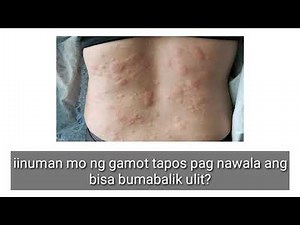 Tagulabay (Urticaria/Hives) Solusyon sa pabalik balik na pantal