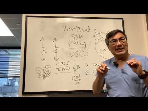 Vertical gaze palsy
