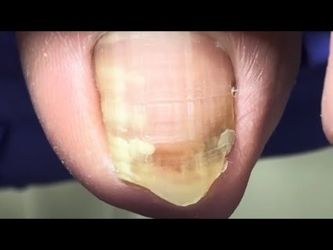 What A Big Piece Of Ingrown Armor! Nail Fungus Infection