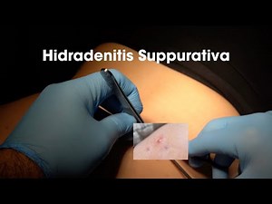 Removing Hidradenitis Suppurativa from a Patient's Shoulder and Back!