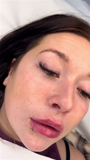 Soft volume. Defined heart. Zero apologies. This isn’t “duck lips”… this is designer. 2ml tailored enhancement JC Beauty & Aesthetics London • Kent • Essex Pretty is common. Precision isn’t.