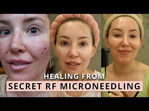 Healing from Secret RF Microneedling Vlog | Does it Actually Work?