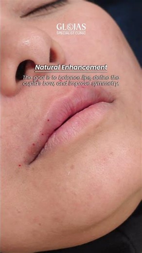 Lip Filler: Ever wonder why it doesn't look obviously fake? 🤔