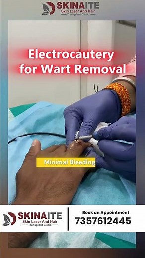 Electrocautery for Wart Removal | Safe, Fast & Effective Wart Removal | Skinaite Clinic