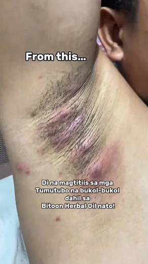 💫 Hanap mo ba ang natural na solusyon sa cyst o bukol? Narito na ang Bitoon Herbal Oil! ✅ Pinapabilis ang paggaling at pagliit ng cyst ✅ Herbal formula, safe gamitin sa araw-araw ✅ Mura pero epektibong alternatibo sa mahal na gamot 🛒 Message us to order! 🚚 Free shipping and COD nationwide! | Shop Sphere