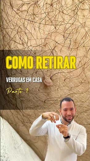 Como retirar verrugas em casa, fibroma mole e acrocórdons. Sem dor. Técnica caseira atualizada.