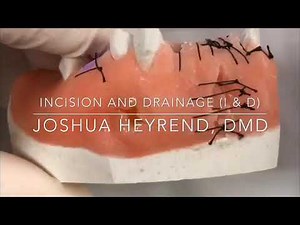 Incision and Drainage (I&D) of Dental Abscess