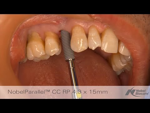 Immediate placement & provisionalization in maxillary esthetic zone │ NobelGuide & NobelParallel CC
