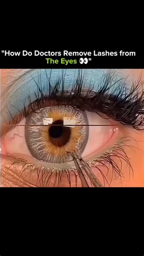 🧿 on Instagram: "Doctors carefully remove eyelashes from the eyes with precision and care 👁️✨ When an eyelash gets stuck in the eye, it can cause irritation, redness, or even scratches on the cornea. Ophthalmologists use sterile tools like fine forceps or a moistened cotton swab to gently lift and remove the lash without damaging the delicate eye surface. Sometimes, the eye is rinsed with saline solution to flush out debris. This careful procedure ensures comfort and prevents infection. It’s a