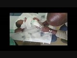 How I do the Ponseti Method for Clubfoot Deformity • Video • MEDtube.net