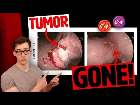 Restricting 2 Amino Acids eliminated Cancer in Clinical Trial!