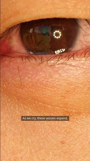 Why Your Eyes Turn Red When You Cry