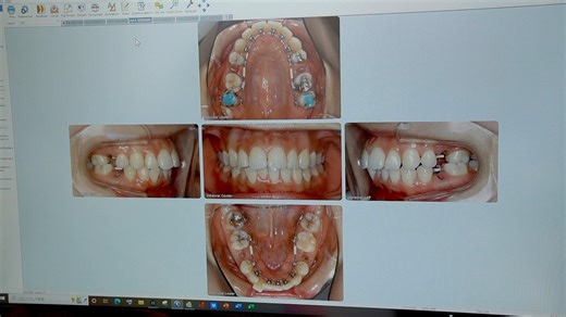 SnapSave.io-おぐっちゃんの裏側矯正日記♯7-(1080p60)