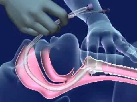 Nasal Intubation