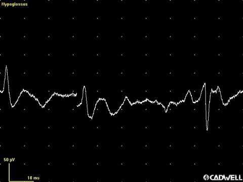 EMG teaching video 4: Fasciculation potentials in the tongue