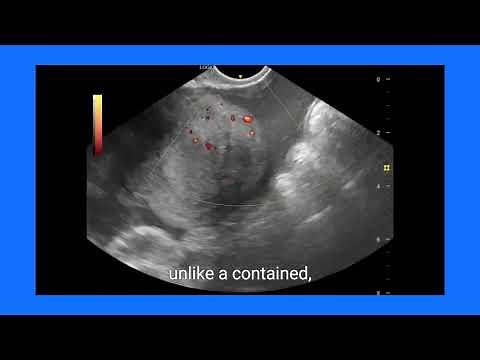 Ruptured Ectopic Pregnancy: Ultrasound & Color Doppler Findings Explained!