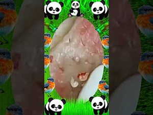 Blackhead removal with NaSa Spa | Satisfying and Relaxation with NaSa Beauty Spa