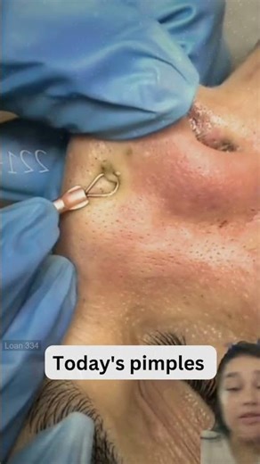 Large Blackheads Extraction Big Cystic Acne Blackheads&Whiteheads Removal Pimple Popping #1176 2026